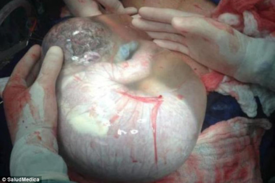 Neonato nel sacco amniotico